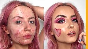 Skin positivity: How I got comfortable with my acne