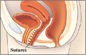 Pelvic Organ Prolapse Surgery For Cystocele
