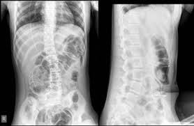 Https Www Jsurgery Org Articles Laparoscopic Management Of Postventriculoperitoneal Shunt Abdominal Pseudocyst In 10 Years Old Girl Pdf
