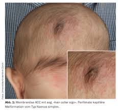 Image result for Nevus Simplex