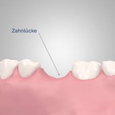 Aus ihr dringen in der regel erst im sechsten bis achten lebensmonat erste zähne hervor. Zahnbrucke Kosten Befestigung Nachteile Vorteile Zahnimplantate Com