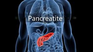 La pancreatitis aguda suele comenzar con un dolor que: Pancreatite Youtube