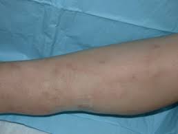 The tetrad of purpura, arthritis, kidney inflammation, and abdominal pain is often observed. Retiform Purpura Dermnet Nz