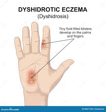 Image result for dyshidrosis
