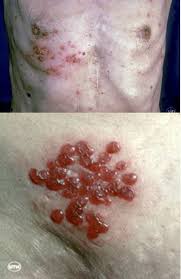Image result for shingles