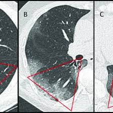 Pdf Low Dose Chest Ct For Diagnosing And Assessing The Extent Of Lung Involvement Of Sars Cov 2 Pneumonia Using A Semi Quantitative Score