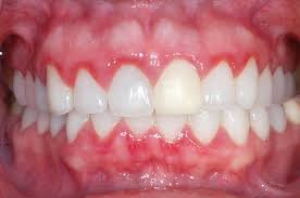 Symptoms, causes, treatments, and prevention. Gingivitis Facts About Gingivitis Mazhuvenchery Speciality Dental Clinic Premier And Leading Dental Clinic In Kochi