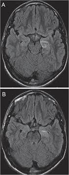 Causes and risk factors for brain cancer the exact cause of brain cancer is unknown. Seizures Caused By Brain Tumors In Children Seizure European Journal Of Epilepsy