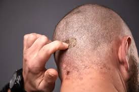 Image result for Seborrheic Dermatitis