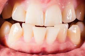 Should I Get Braces Or Invisalign Greenspoint Dental