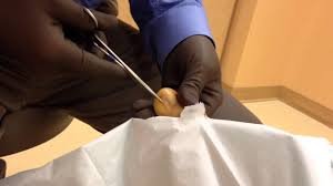 Once it's inside, it will protect against pregnancy for up to 10 years, depending on the type. Procedure Videos Dr Jeff M D