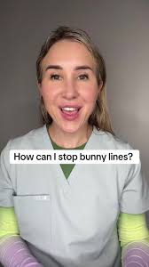 🤍 Bunny lines or nasal scrunch lines are lines that appear at the sides of  the nose they radiate from the inner canthus like a starburst and overtime  they get deeper and etched like any other wrinkle ...