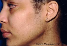 The first signs of an ingrown facial hair. Hirsutism American Osteopathic College Of Dermatology Aocd