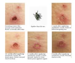 Image result for wolf spider bite skin