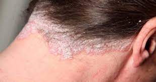 Seboreik Dermatit Gunumuzun Cok Yayin Bir Hastaligi Olmasina Ragmen Cok Rahat Bir Sekilde Tedavisi Yapilabilmektedir Sac Dogal Cilt Saglikli Yasam