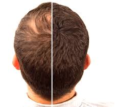 Eating disorders such as bulimia and anorexia that involve starving yourself or regurgitating eating food. Best Hair Loss Treatment For Men S Rejuvenate Hair