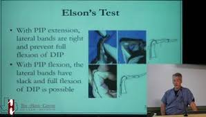 Image result for Elson Extensor Tendon Test
