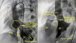 Image result for Nuclear Ventriculogram