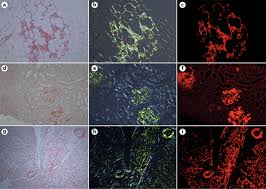 Congo red (cr) is the most popular dye used as a probe for diagnosing amyloidosis, a very heterogeneous group of diseases with more than 23 electron and immunoelectron microscopy of abdominal fat identifies and characterizes amyloid fibrils in suspected cardiac amyloidosis. Systemic Immunoglobulin Light Chain Amyloidosis Nature Reviews Disease Primers