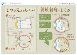 ものが見えるしくみと網膜剥離のしくみ infographics 治療 看護ノート 医学