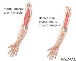 Muscles are generally attached at two points in the body. Muscle Atrophy Information Mount Sinai New York