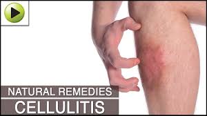 Taking antibiotics is known as the most common cure for cellulitis treatment. Home Remedies For Cellulitis Youtube