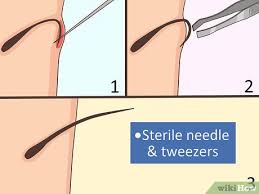 3 ways to remove an ingrown hair wikihow
