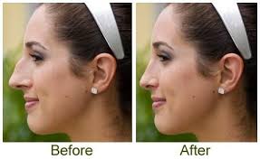 Pin On Cosmetic Surgery
