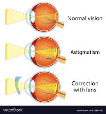 Astigmatism Corrected By A Cylindrical Lens