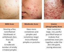 In other cases, it's a symptom of a common, treatable skin condition. Acne Articles Dis Chem
