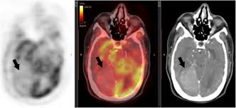 A pet scan is not specific for cancer. Brain Metastases Assessment By Fdg Pet Ct Can It Eliminate The Necessity For Dedicated Brain Imaging Egyptian Journal Of Radiology And Nuclear Medicine Full Text
