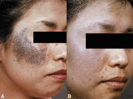 John Libbey Eurotext European Journal Of Dermatology Treatment Of Ota S Nevus By Q Switched Alexandrite Laser Therapeutic Outcome In Relation To Clinical And Histopathological Findings