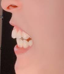 May 27, 2021 · 敵「出っ歯ひどいから矯正だけしても多分そこまで良くならんけどやるか？ 117: å†™çœŸã‚ã‚Š å‡ºã£æ­¯ã‚'çŸ¯æ­£ã—ãŸã‚‰æ­¯èŒŽã‹ã‚‰ã®å‡ºã£æ­¯ã«ãªã£ã¦ã—ã¾ã£ãŸ æ­¯ãƒãƒ£ãƒ³ãƒãƒ«æ­¯ç§'ç›¸è«‡å®¤