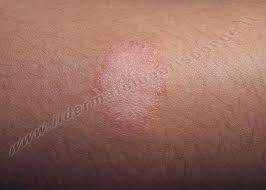 Image result for Eczema nummulare