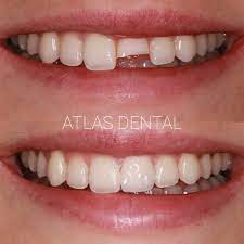 This Young Lady Called Our Office On A Sunday Morning Looking For Help After Falling Face First Emergency Dental Services Dental Services Dental