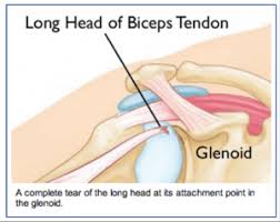 Maybe you would like to learn more about one of these? Biceps Tendon Tears Orthopedic Specialists Of Seattle