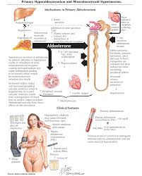 Image result for Hyperaldosteronism