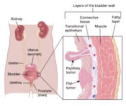 If You Have Bladder Cancer