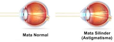 Untuk dapat melihat jauh dengan jelas dan untuk membaca pada jarak normal, penderita presbiopi dapat ditolong dengan kaca mata berlensa rangkap (kacamata bifokal). Jenis Jenis Cacat Mata Penyebab Dan Cara Mengatasinya