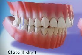 Freddie had extra teeth that caused them to protrude. Freddie Mercury And Class Ii Malocclusion With Overbite Clinica Pardinas