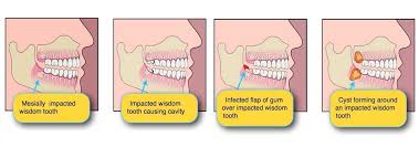 Baby teeth and teeth that are loose due to. Do I Need To Remove My Wisdom Tooth South Perth Dental Excellence