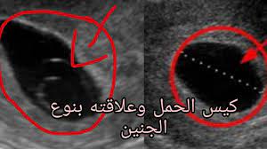 متى يظهر كيس الحمل بالرحم بوابة دوت كوم