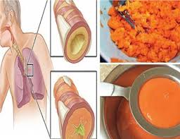 Untuk meredakan batuk, para penderita untuk menjadi obat batuk, jintan perlu dicampur dengan bahan lain. Petua Hilangkan Kahak Dalam Paru Paru Dan Penawar Batuk Yang Mujarab My Info Maya