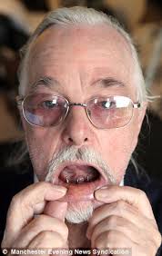 Pensioner left with SPIKES for teeth as dentists argue who should treat him 