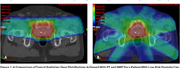 Radiation therapy is a common treatment for several types of cancer. Pdf Proton Therapy For Prostate Cancer Semantic Scholar