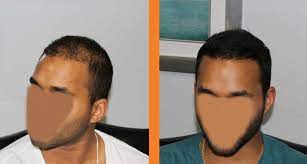 Diffuse thinning is a condition which affects many people and can happen at any age to either gender. Patient 13 Hair Transplant On Patient With Advanced Diffuse Hair Loss