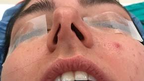 Check spelling or type a new query. Deviated Septum Deviated Airway Adult And Child Plastic Surgery