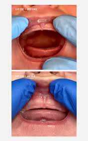 Image result for Ankyloglossia