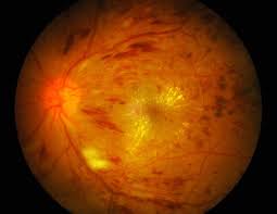 This means you may have had to wait longer than usual for your routine diabetic eye screening appointment. Diabetic Retinopathy Risk Factors
