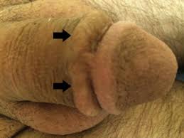 It sometimes occurs in the arm or penis. References In Penile Mondor Disease And Its Effect On Erectile Function Results Of 30 Patients Urology